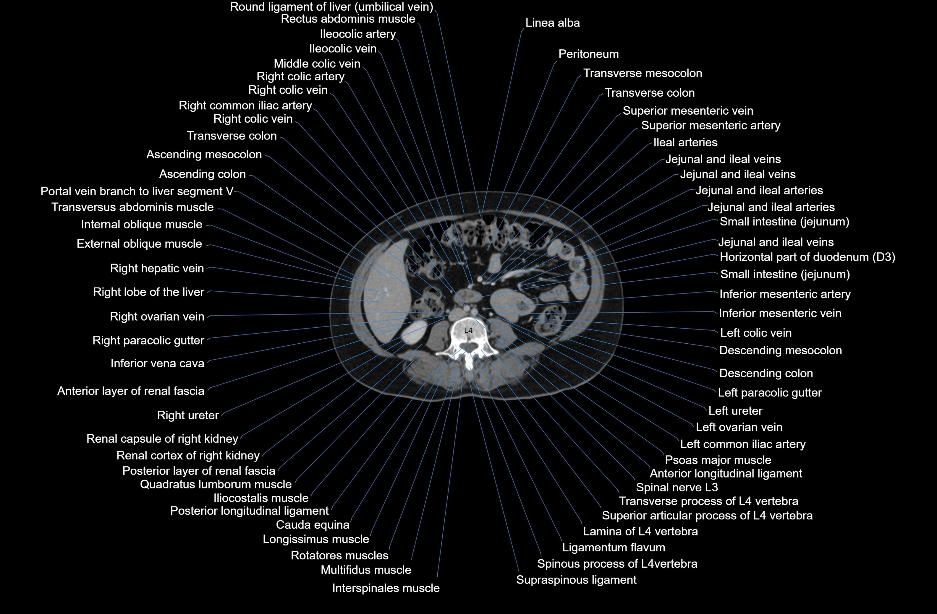 CT Abdomen axial cross sectional anatomy labelled radiology image-00050.webp